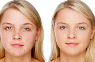 Как скрыть прыщи на лице