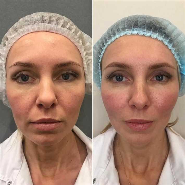 Стоит ли делать аппаратную подтяжку лица СМАС-лифтинг?