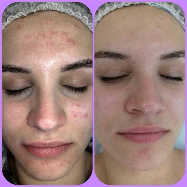 1. Не трогайте лицо руками