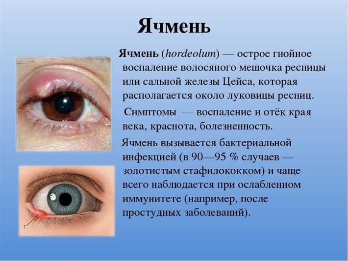 Предрасполагающие факторы к развитию ячменя