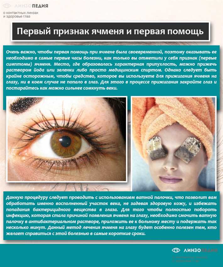 Как предотвратить появление ячменя?