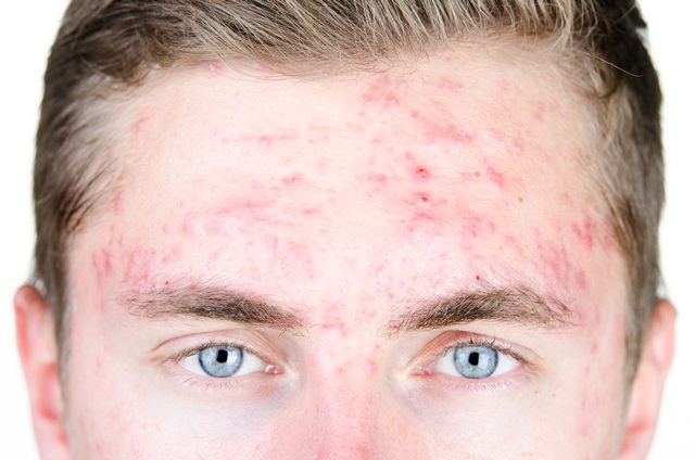 Как избавиться от прыщей на теле и устранить их следы с помощью доступных средств