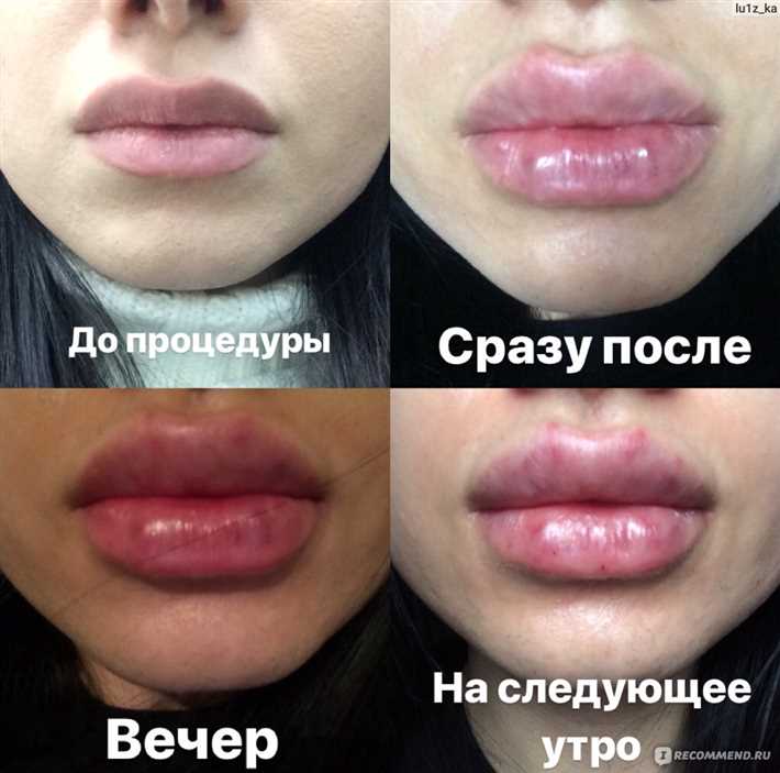 Механизм действия гиалуроновой кислоты