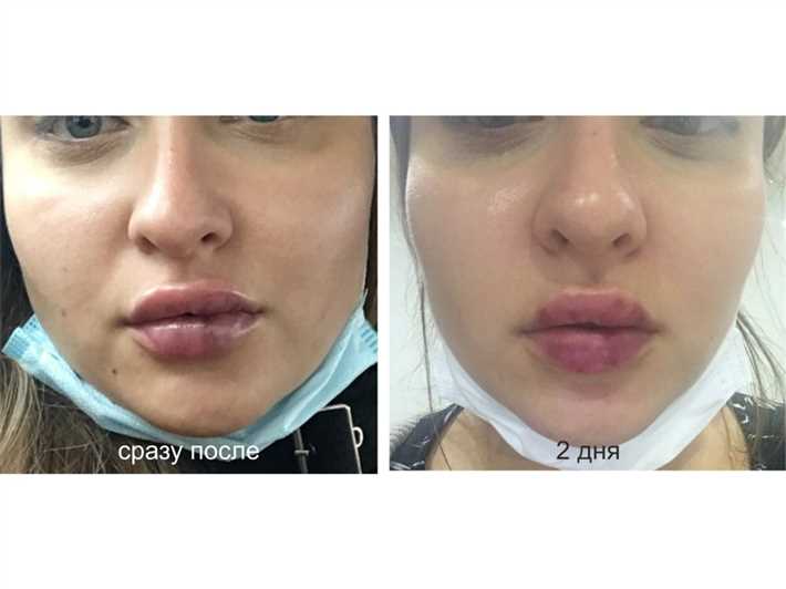 Последствия синяков после увеличения губ гиалуроновой кислотой