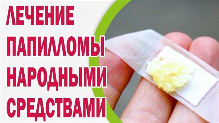 2. Криодеструкция