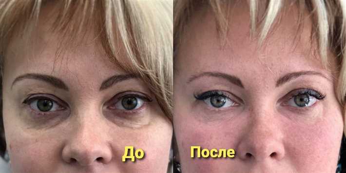 Причины возникновения морщин под глазами: