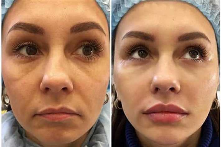 Ручное удаление гиалуроновой кислоты из губ