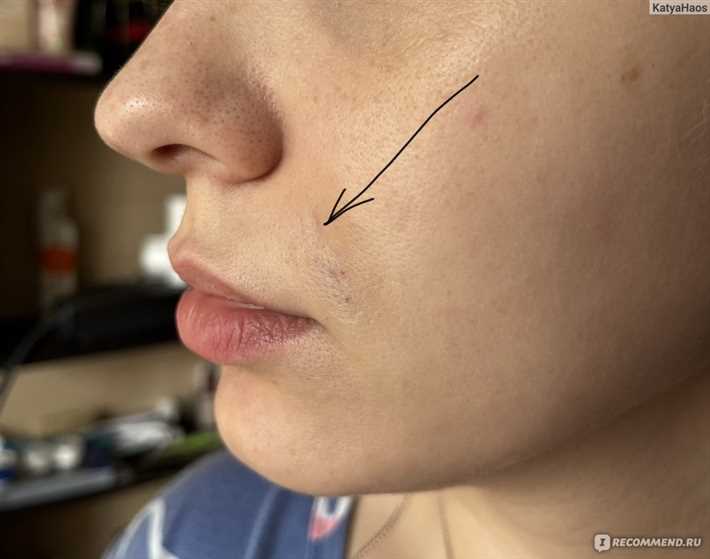 Действия после удаления гиалуроновой кислоты