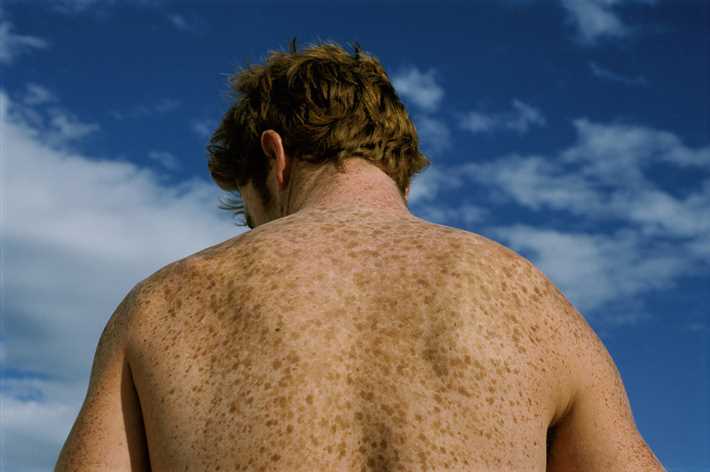 Естественные способы борьбы с прыщами