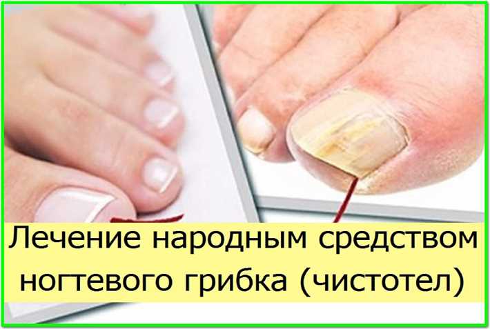 Как можно вылечить грибок ногтей дома?