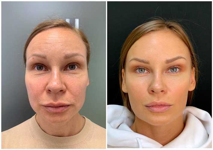 Преимущества процедуры ультраформер лифтинга