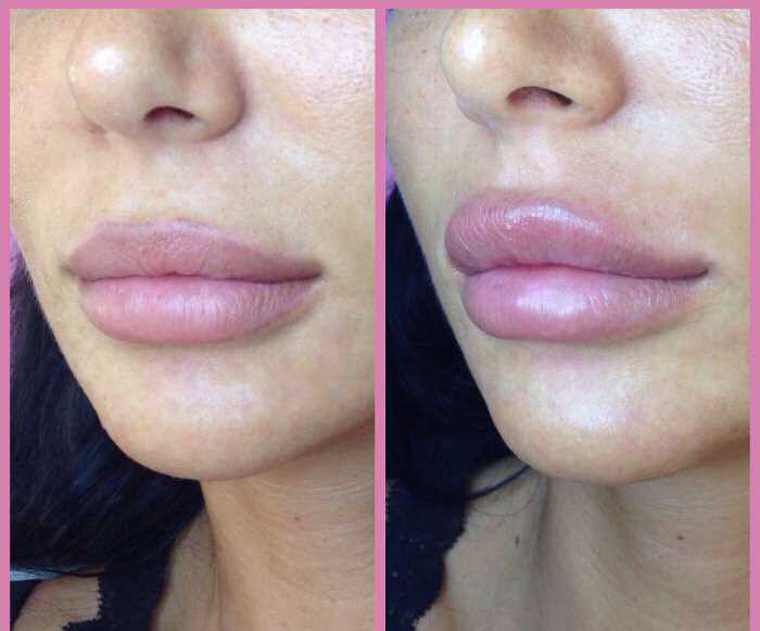 Правильный уход после увеличения губ