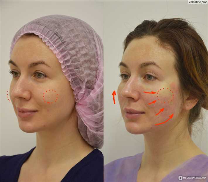 Как проходит процедура подтяжки лица нитями