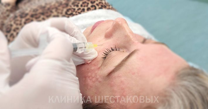 Сколько держатся папулы после биоревитализации