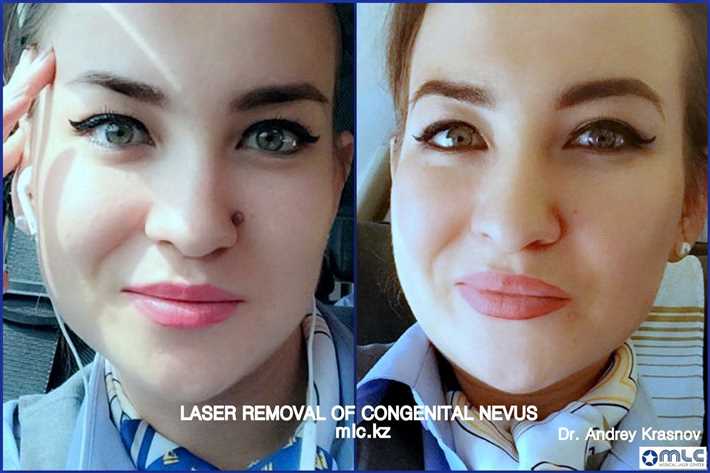 Лазерное удаление родинок
