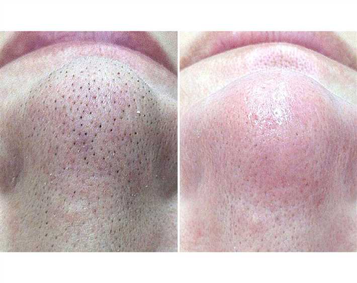 Ультразвуковая чистка лица в домашних условиях